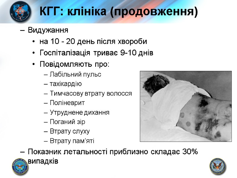КГГ: клініка (продовження) Видужання на 10 - 20 день після хвороби Госпіталізація триває 9-10